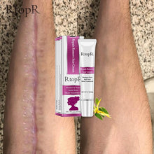 Load image into Gallery viewer, RtopR Scar Remover Cream For Stretch Marks, Acne And More!