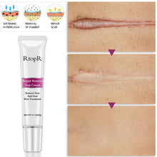 Load image into Gallery viewer, RtopR Scar Remover Cream For Stretch Marks, Acne And More!
